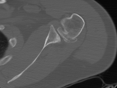 Static Posterior Shoulder Subluxation